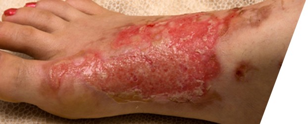 Quemaduras ¿Qué hacer?