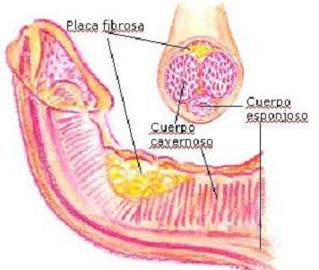 Enfermedad de Peyronie