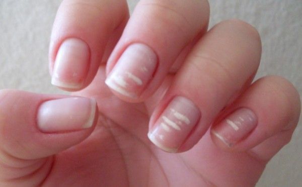 Manchas blancas en las uñas o leuconiquia