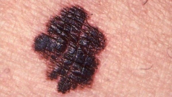 Melanoma –  Responsable del 80% de muertes por cáncer de piel