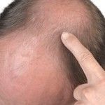 La calvicie masculina o alopecia y el DHT