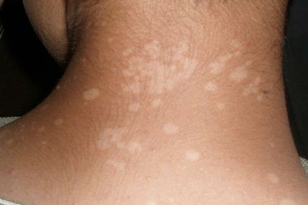 Dermatomicosis u hongos en la piel – En verano más