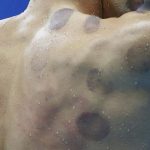 cupping o ventosaterapia. Terapia con ventosas.