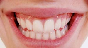 gingivitis y periodontitis por placa bacteriana