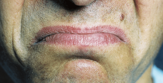 Sabor metálico en la boca (disgeusia) – Causas y síntomas
