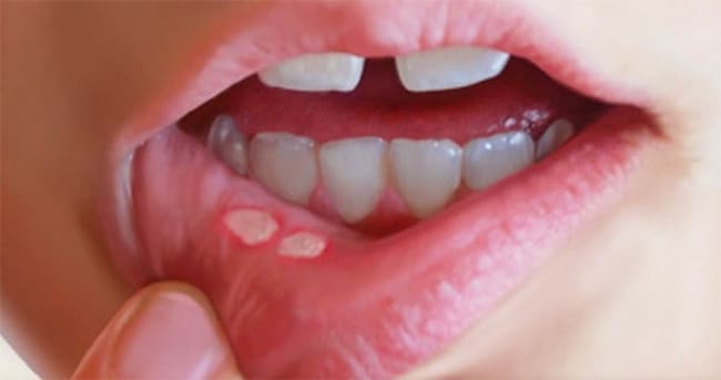 ¿Qué son las molestas aftas bucales o úlceras aftosas?