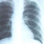 European régimen Accelerator for Tuberculosis