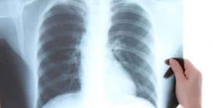 European régimen Accelerator for Tuberculosis
